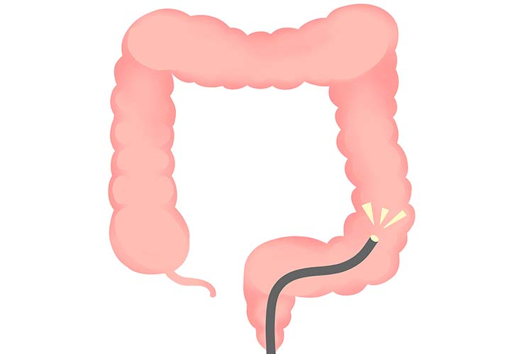 大腸カメラのイメージ画像